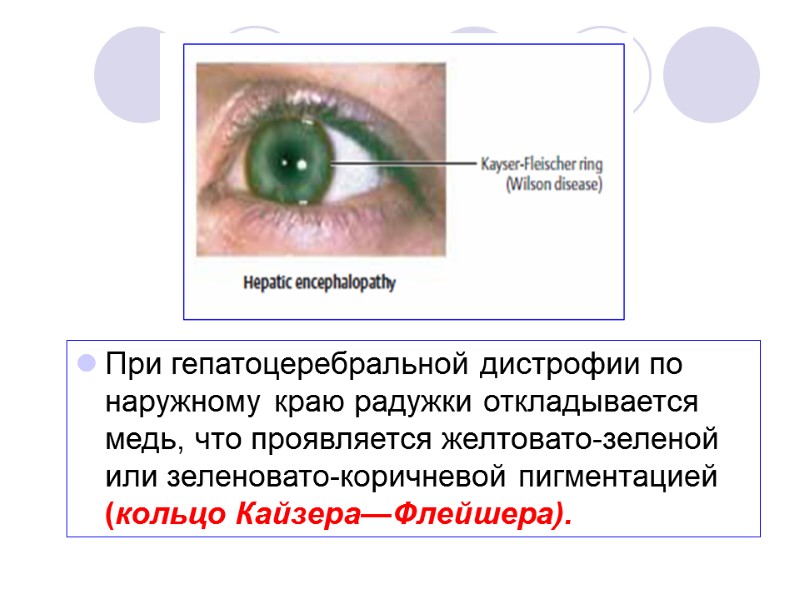При гепатоцеребральной дистрофии по наружному краю радужки откладывается медь, что проявляется желтовато-зеленой или зеленовато-коричневой